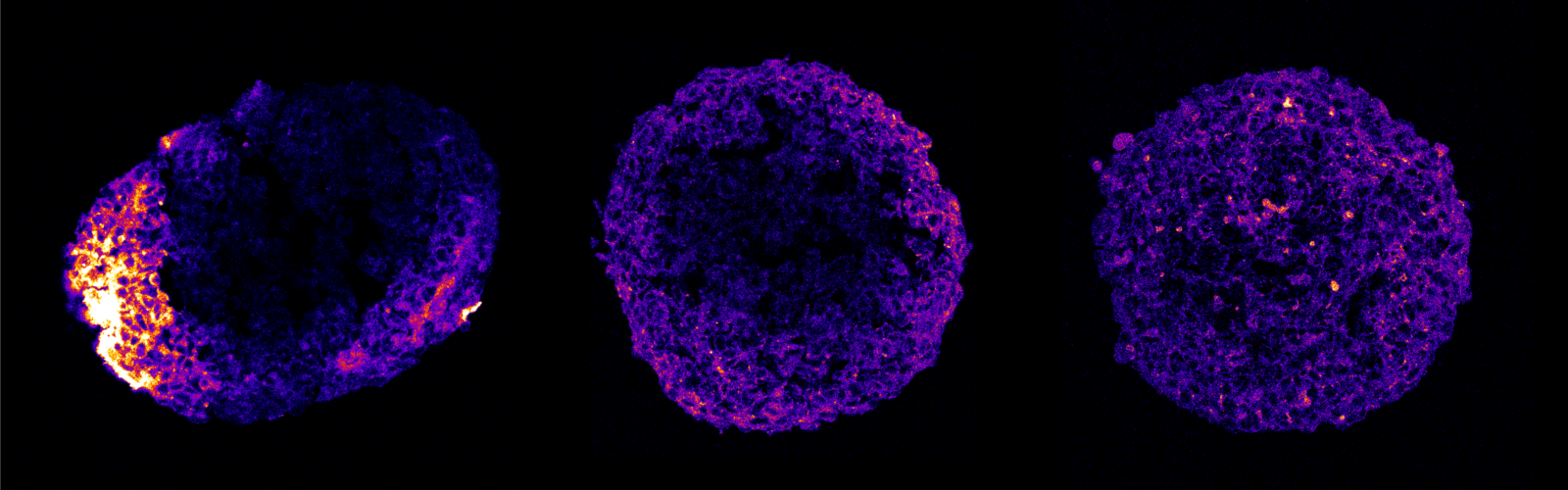 Fluorescently tagged nanoparticles are shown penetrating brain cancer spheroids.